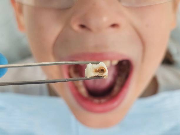 Best Emergency Tooth Extraction in Palmyra, MO